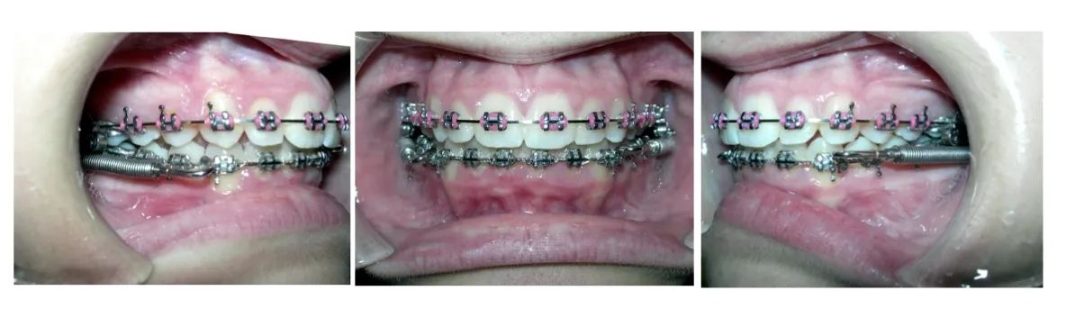 Forsus springs attached to braces, shown from the left side, front and right side