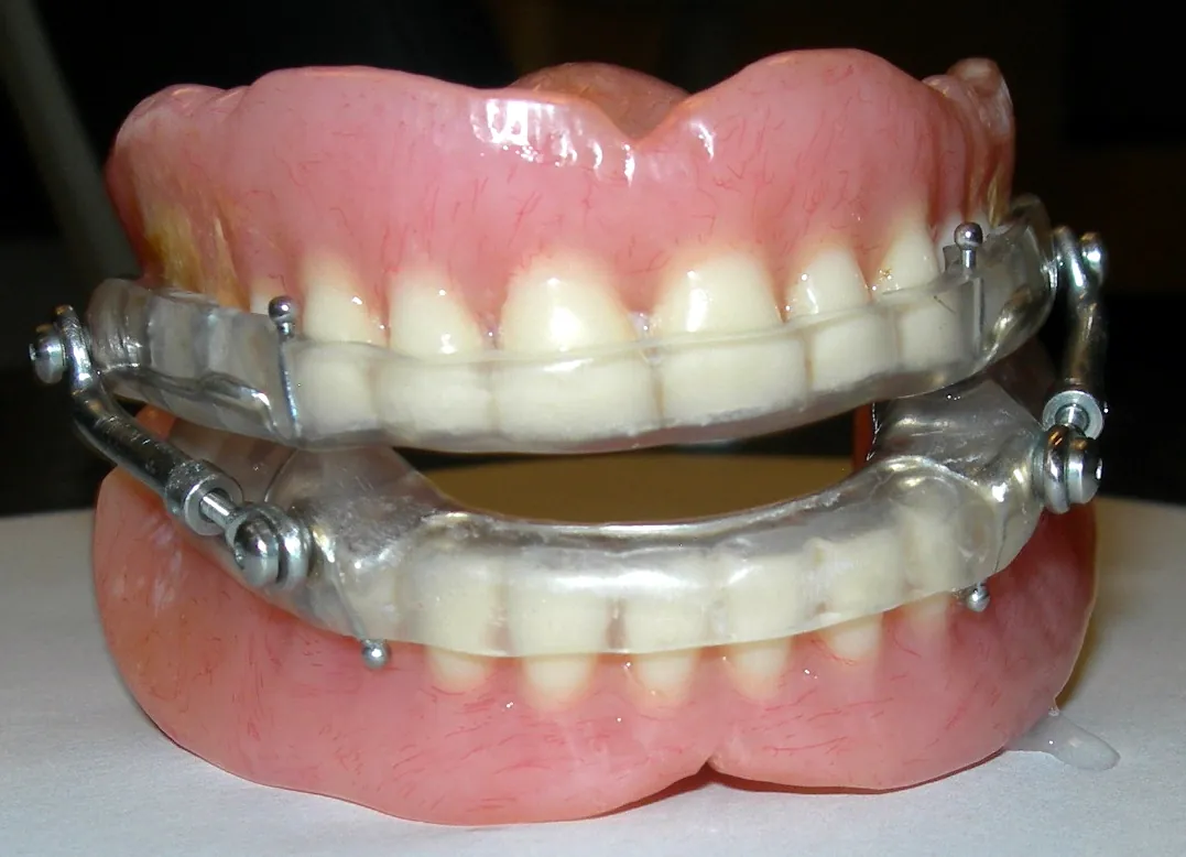 Sleep apnea oral appliance fitted over a set of full dentures