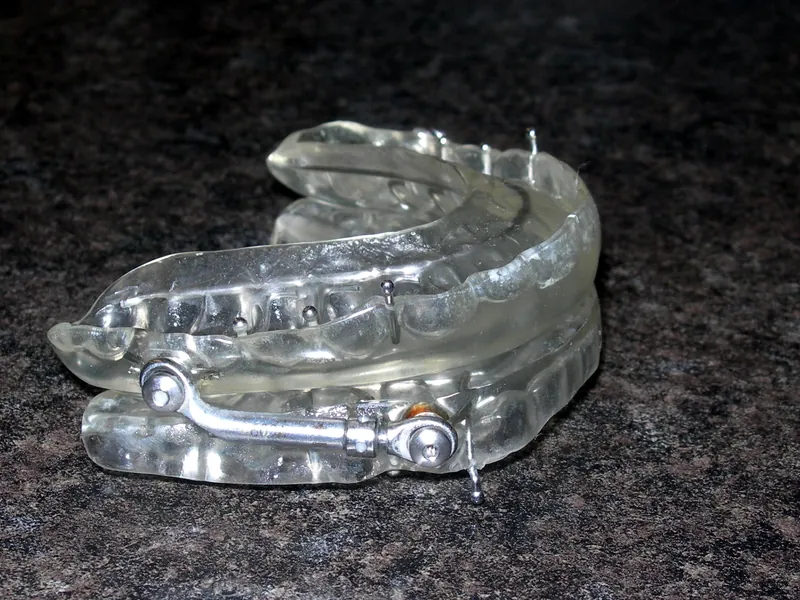 Custom sleep apnea oral appliance, clear trays connected by small metal hinges
