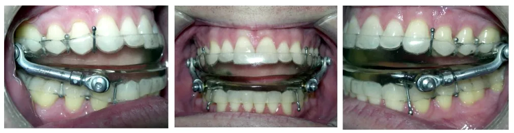 Sleep apnea oral appliance being worn, shown from the left side, front and right side