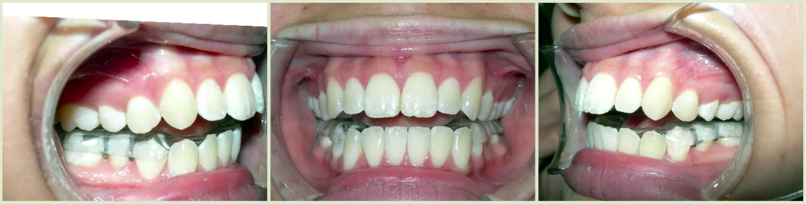 Clear custom TMD orthotic worn over the lower teeth, shown from the left side, front and right side