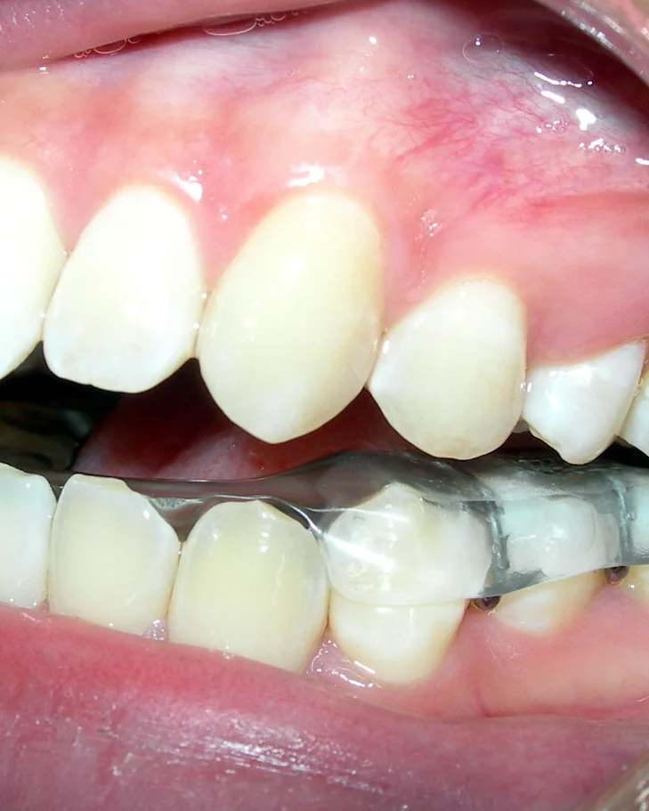 Close-up of a clear custom TMD splint worn over the lower teeth