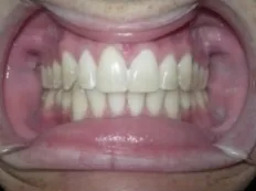 After treatment: top teeth sat too far forward