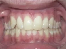 Before treatment: top teeth sat too far forward
