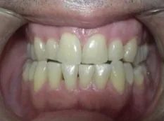 Before treatment: lower teeth sat ahead of the uppers