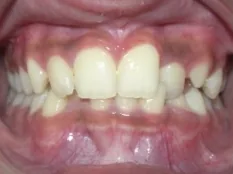 Before treatment: crooked, crowded teeth with a crossbite