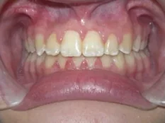 After treatment: crowded teeth and a deep bite