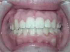 After treatment: canines came in high and out of place