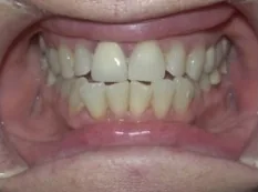 Before treatment: front teeth met edge to edge