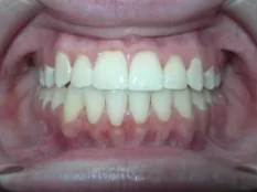 After treatment: edge-to-edge front teeth