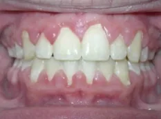After treatment: top teeth stuck far out