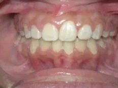 After treatment: front teeth didn't touch