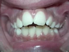 Before treatment: top teeth stuck out past the bottoms