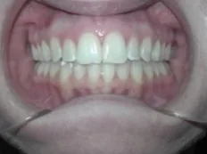After treatment: back teeth didn't meet