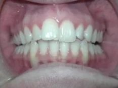 Before treatment: back teeth didn't meet