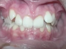 Before treatment: top teeth covered the bottoms