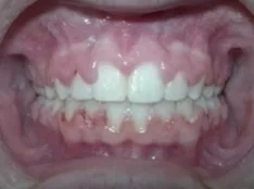 After treatment: gaps between the front teeth