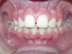 Before treatment: gaps between the front teeth