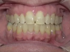After treatment: gaps closed for an adult patient