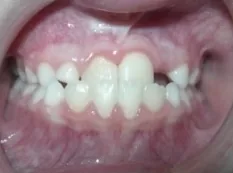 Before treatment: underbite caught early