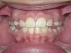 After treatment: underbite corrected in phase i