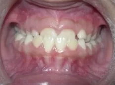 Before treatment: underbite corrected in phase i
