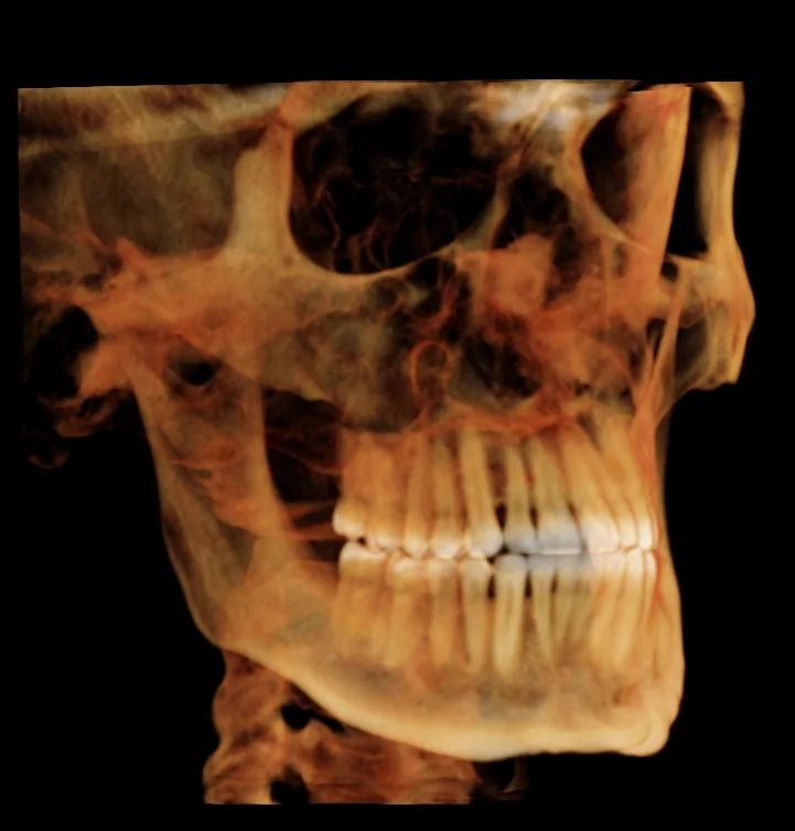 3D iCAT rendering of the jaws and teeth at an angle