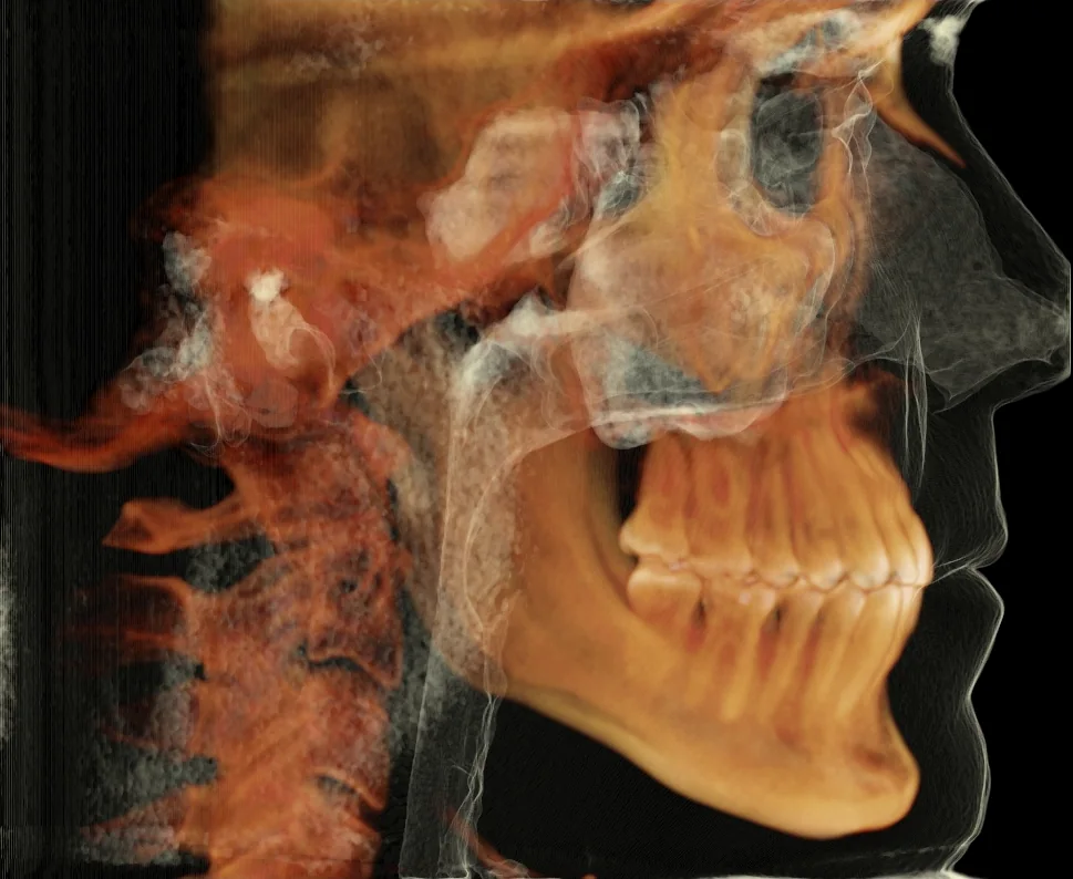 3D iCAT rendering of the skull, jaws and teeth from the side